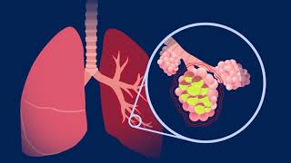 Understanding Pneumococcal Pneumonia [upl. by Ernald]