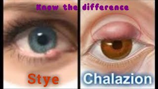 Difference between Stye and Chalazion [upl. by Celle]