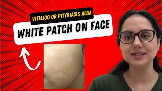 White patch on face Is this Vitiligo or Pityriasis alba II Dr Surbhi MD [upl. by Lynna]