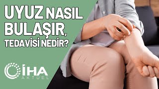 Uyuz Nasıl Bulaşır Tedavisi Nedir [upl. by Girhiny]