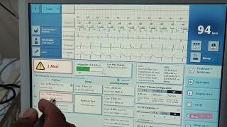 Cardiac Resynchronisation Therapy Defibrillator  CRTD   Heart Device [upl. by Garaway894]