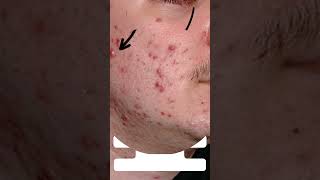 The Ultimate Guide to Treating Papulopustular Acne [upl. by Odravde74]