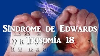 Síndrome de Edwards Trisomía 18 [upl. by Waxler]