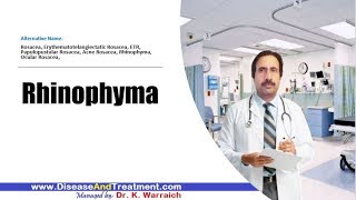 Rhinophyma  Causes Diagnosis Symptoms Treatment Prognosis [upl. by Tessa711]