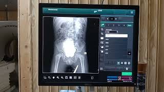 MCUG  micturating cystourethrogram procedure  mcug x ray  easy way to perform mcug x ray [upl. by Friede]