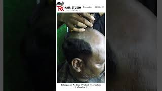 hair patch Kitne din Chalta haihairpatch hairreplacment confidenceboost hair beauty hairstyle [upl. by Anyzratak358]