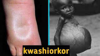 kwashiorkor and its symptoms [upl. by Oballa854]