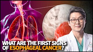 What is Esophageal Cancer What are the first signs of Esophageal Cancer [upl. by Reginauld370]