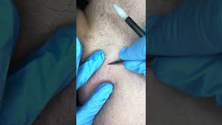 Watch electrolysis Back hairs permanent hair removal [upl. by Marj883]