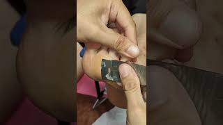 Callus removal and Dead skin removal from Feet ep74  Yin Clinic [upl. by Nie472]