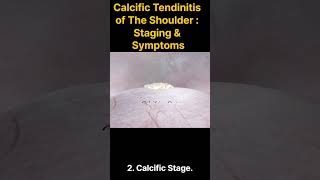 Calcific Tendinitis of The Shoulder  Stage related Symptoms [upl. by Rengaw977]