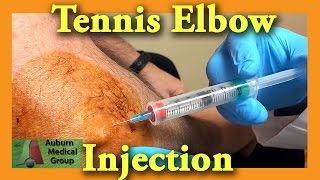 Tennis Elbow Cortisone Injection  Auburn Medical Group [upl. by Nylodam]