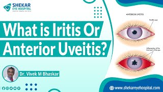 Iritis  Anterior Uveitis  Shekar Eye Hospital [upl. by Schultz670]