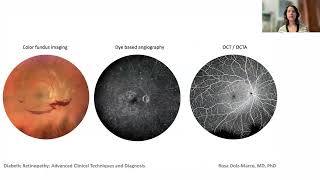 Lecture Diabetic Retinopathy Clinical Techniques and Diagnosis for Patient Monitoring amp Management [upl. by Gershom]