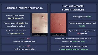 Erythema Toxicum Neonatorum vs Transient Neonatal Pustular Melanosis [upl. by Cathleen783]