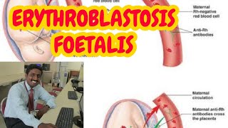 ERYTHROBLASTOSIS FOETALIS  TAMIL EXPLANATION [upl. by Meesaw268]