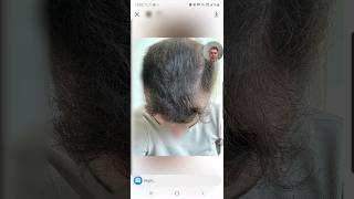 Amazing Regrowth In Just 10 Weeks By FinasterideMinoxidil [upl. by Neelrad582]