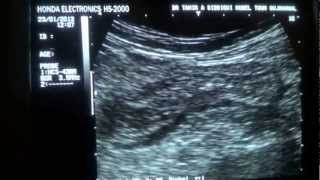 DIVERTICULITIS sigmoidocolonic [upl. by Kinom866]