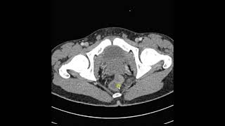 Obstrução intestinal [upl. by Brucie]