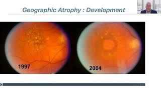 Lecture Dry AgeRelated Macular Degeneration AMD Update New Therapies [upl. by Neural56]