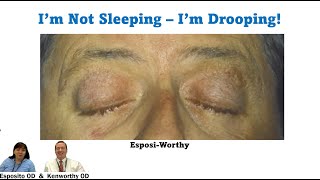 Can you remember these five things that cause ptosis [upl. by Aihcrop]