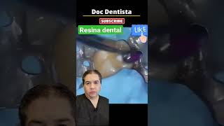 Resina dental como se hace un empaste o relleno en la boca shorts [upl. by Goldshlag]