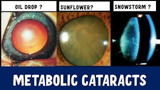 Metabolic Cataracts of the Eye [upl. by Erasmo268]