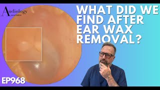 WHAT IS THIS LUMP EAR WAX REMOVAL  EP968 [upl. by Wilek]