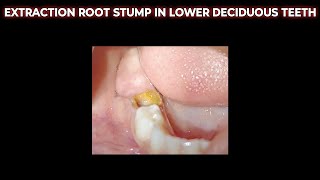 ROOT STUMP EXTRACTION  EXTRACTION ROOT STUMP IN LOWER DECIDUOUS TEETH  DAAT KA JAAD NIKALNA [upl. by Hcelemile]