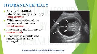 Hydranencephaly fluid filled fetal brain differentials  A2Z of Ultrasound [upl. by Tugman]