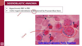 Hematology  1  U8L4  Sideroblastic anaemia [upl. by Kirch642]