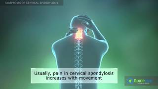 Cervical Spondylosis Symptoms [upl. by Ahkeber]