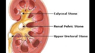 Shockwave sa Bato sa Kidney  ni Dr Ryan Cablitas Urologist 6 [upl. by Aicined]