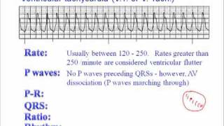 ECG Ventricular Tachycardia VT [upl. by Anelegna]