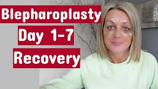 My Eye Surgery UpperampLower blepharoplasty  Day 17 Recovery [upl. by Althea]