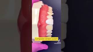 Composite veneers system DentalHealthTips [upl. by Iow]