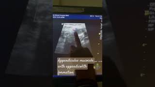 Appendicular mucocele with Appendicolith formation ultrasound surgeon unfrezzmyaccount foryou [upl. by Kurland318]