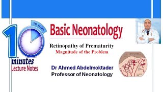 Retinopathy Of Prematurity [upl. by Ordnagela]