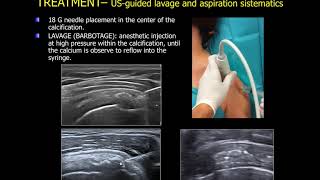 echoguided lavage of the calcific tendinitis of the shoulder [upl. by Oetsira]