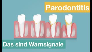 Parodontitis [upl. by Cired]