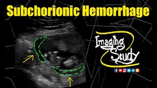 Subchorionic Hemorrhage  Ultrasound  Case 193 [upl. by Anined394]