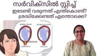 Short cervix during pregnancy malayalam cerclagecervix stitch malayalam drchithra pregnancytips [upl. by Rickard]