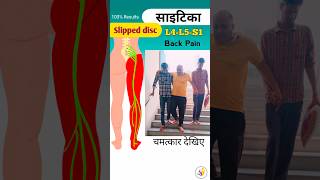 😱साइटिका का दर्द  Nerve Root Compression✅🔥🔥 sciatica [upl. by Ahsenra807]