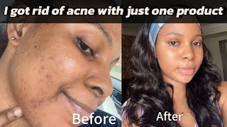 How I cleared my acne using one product my honest review on clean and clear cleanseracne journey [upl. by Airolg]