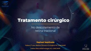 Retina e Vítreo 21112024  Tratamento Cirúrgico no Descolamento de Retina Tracional [upl. by Dnomar]