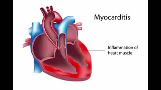 Myocarditis History Management mrcpch Clinical [upl. by Hehre]