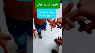 Stiff and weak muscle disease  myotonia congenita amp muscular dystrophy  urdu amp hindi myotonia [upl. by Acima]