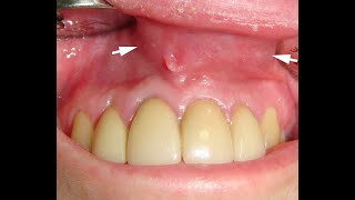 Odontogenic cyst insinuating a nasolabial cyst [upl. by Kcyred]