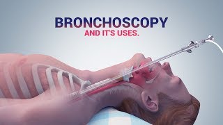 BRONCHOSCOPY  ITS USES I DR NAVEEN KUMAR AILAWADI I CHEST SPECIALIST [upl. by Nahgiem]