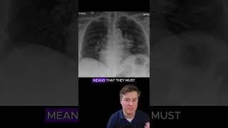 Hilum overlay sign  chest xray interpretation radiology medicalstudent radiologist [upl. by Nolrak]